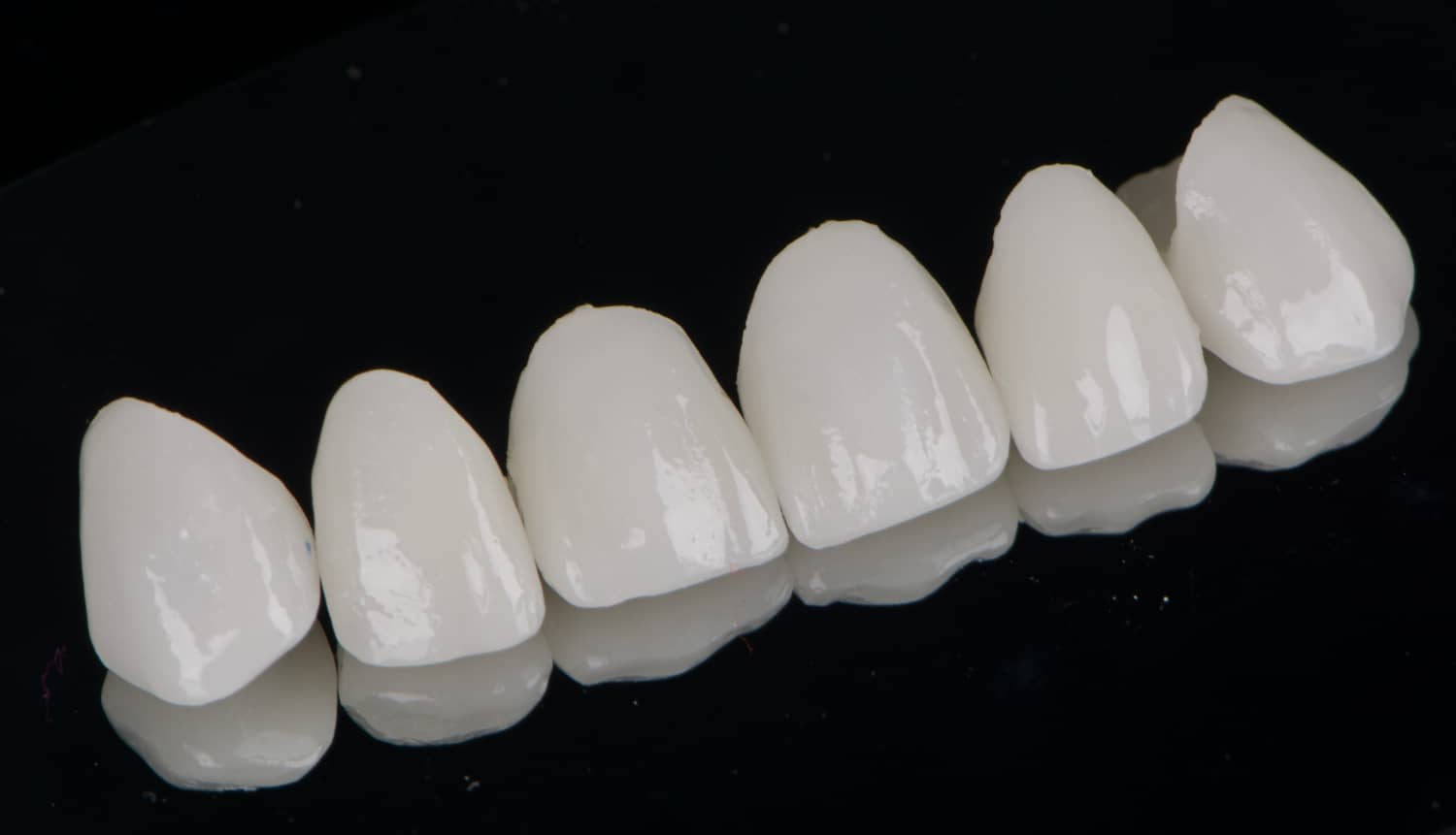 carillas-ceramicas- carilas de porcelana