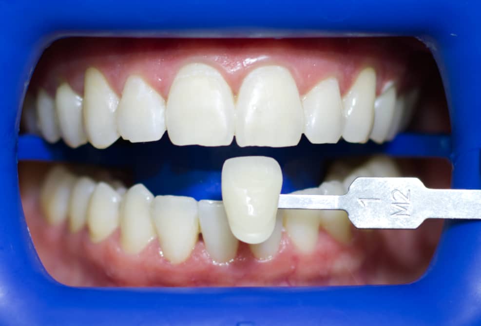 blanqueamiento dental providencia blanqueamiento dental providencia