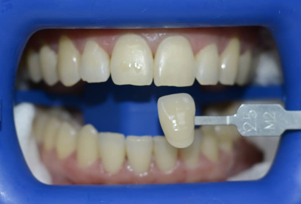 blanqueamiento-antes blanqueamiento dental providencia