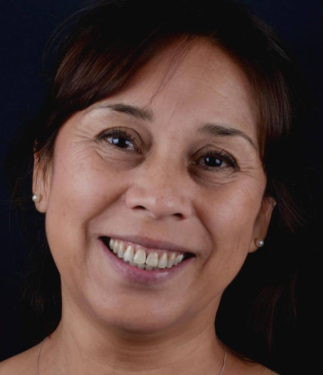 estetica-dental-providencia carillas dentales providencia