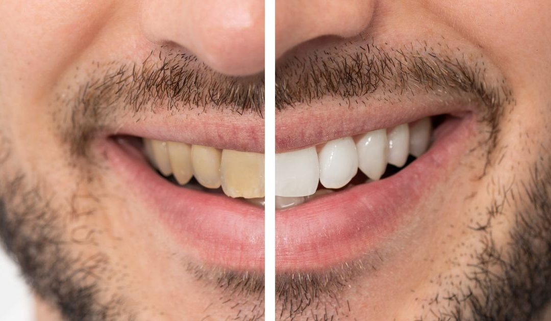 Mitos del blanqueamiento dental: lo que realmente funciona