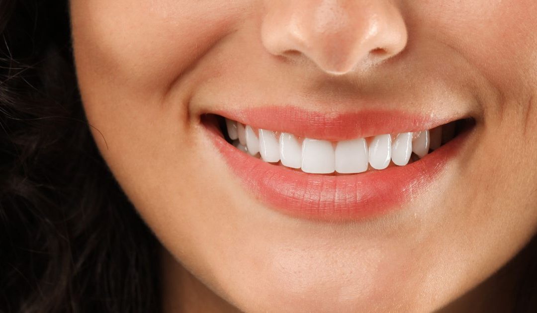 Carillas dentales: cómo funcionan y qué ventajas ofrecen