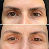 ACIDO HIALURONICO ojeras ACIDO HIALURONICO ojeras