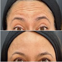 BOTOX Suaviza líneas de expresión y previene arrugas. BOTOX Suaviza líneas de expresión y previene arrugas.