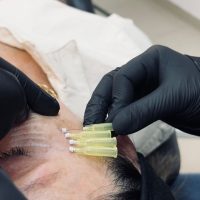 Bioestimuladores rostro Bioestimuladores rostro